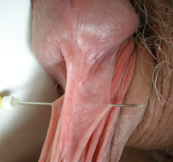 Needle sting cock. Super excitement. 
I like this kind of D
