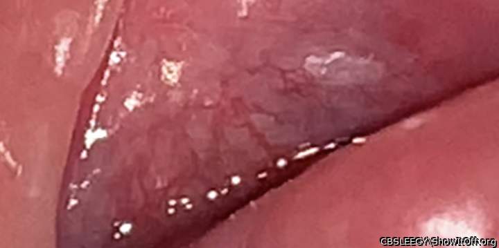 Skin tag inside my Uretha!