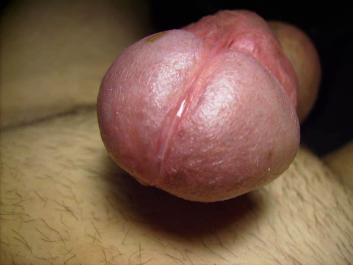 Photo of a penile from berndconsum