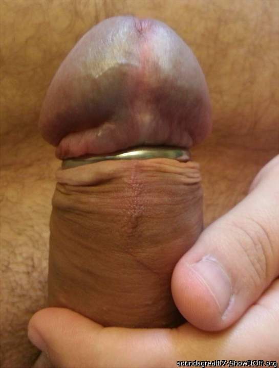 Steel glans ring holds my foreskin back