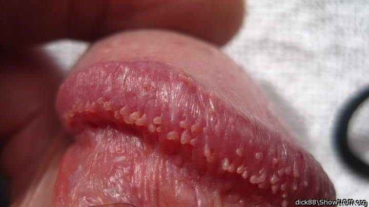 Love those pearly papules