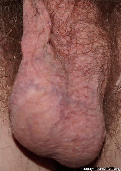 my scrotum