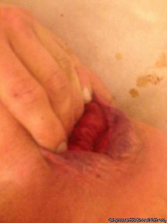 A nother prolapse