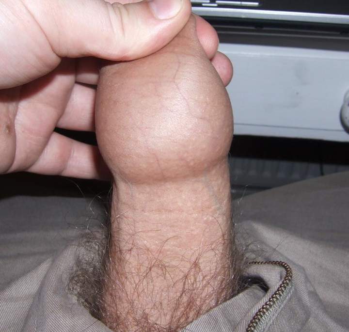 Flesh Balloon!