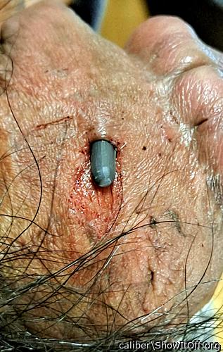 implant