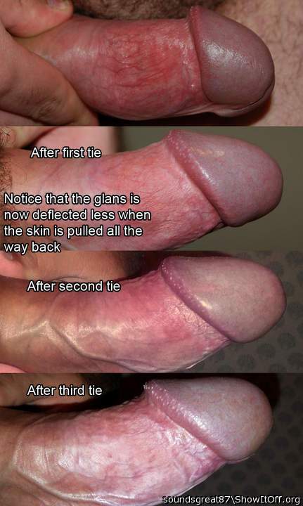 Change in my frenulum over three ties - erect side