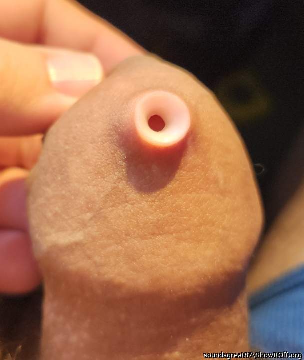 Foreskin Buttonhole in progress (2ga, 6mm)