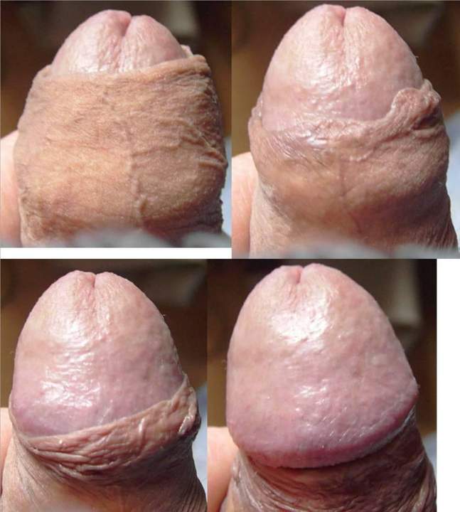 I know how great it feels on the glans when you peel that ba