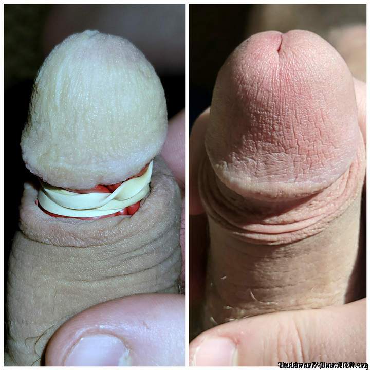 glans banding