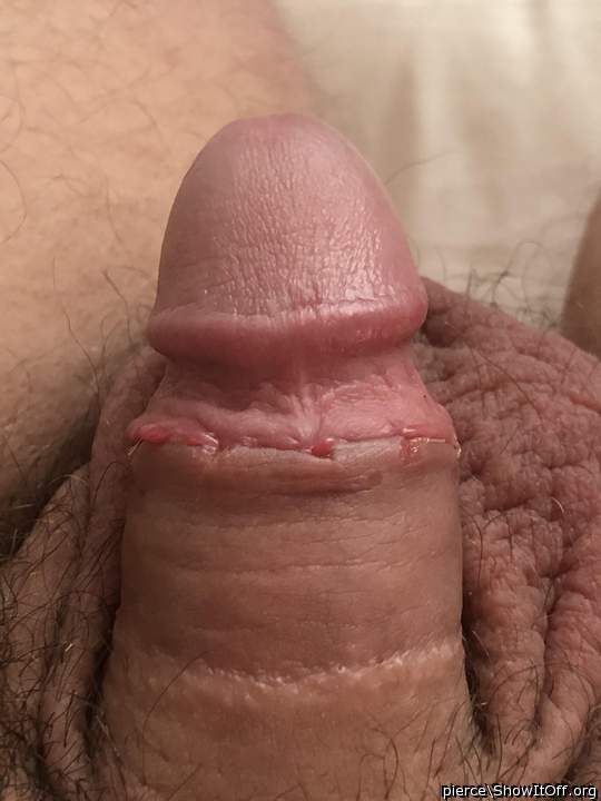 My circumcision after a week
