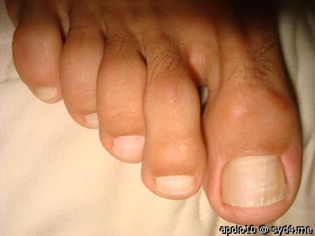My Toes