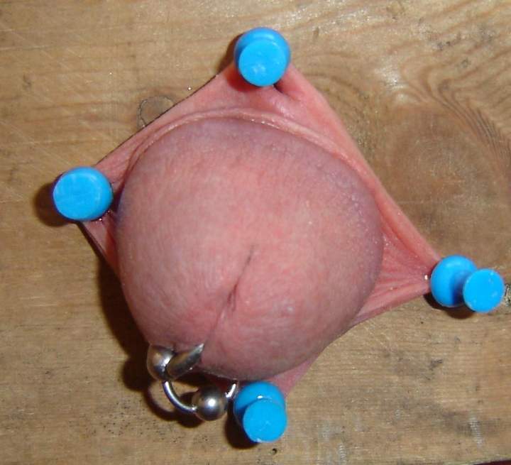 Foreskin pegged out
