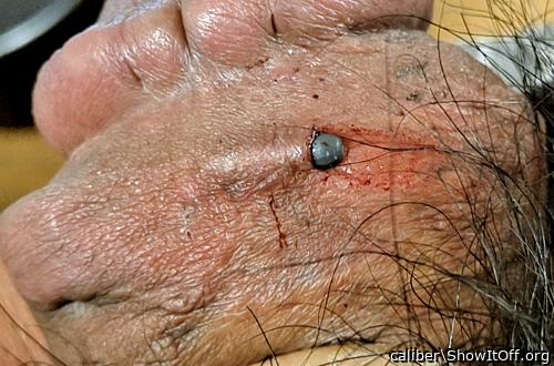 implant