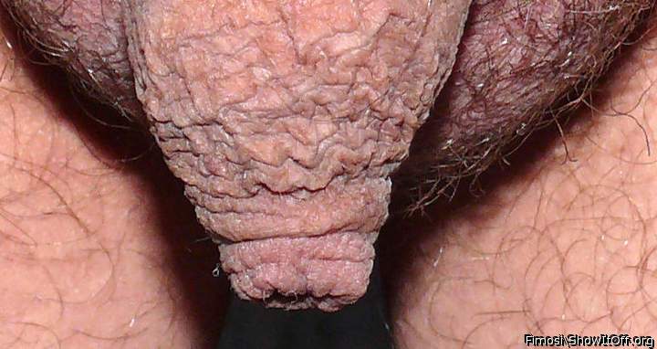 foreskin