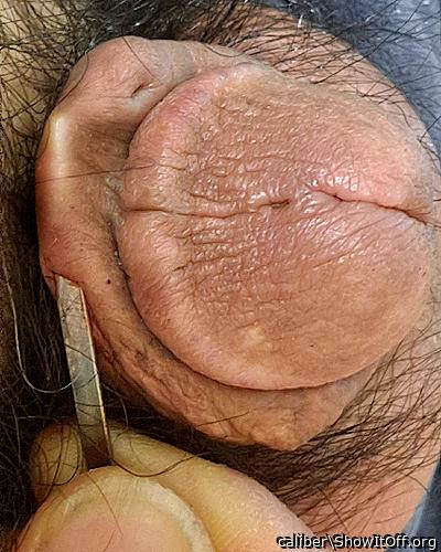 implant