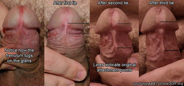 Change in my frenulum over three ties - flaccid