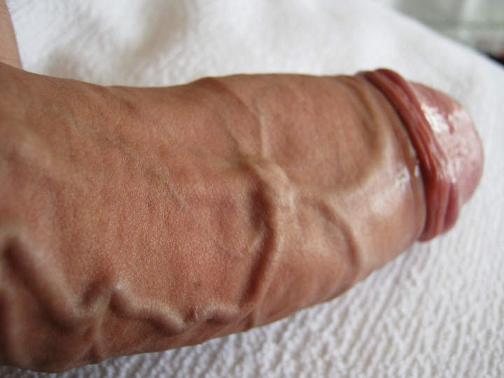 veins