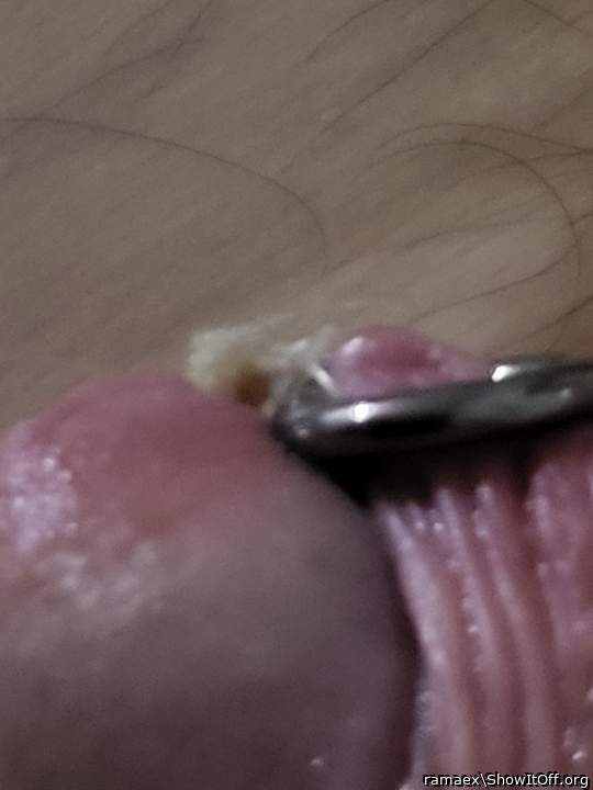 bound frenum above the frenum-ring to cut frenum