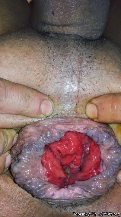My loose prolapsed ass
