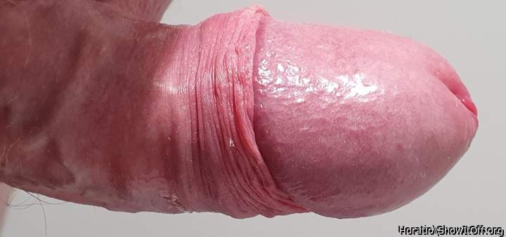 Turtle neck foreskin
