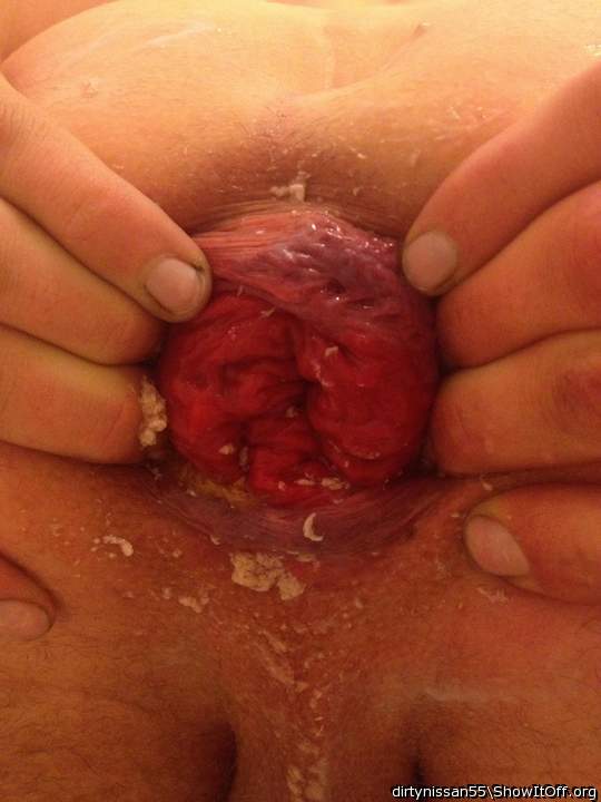 A nice prolapse