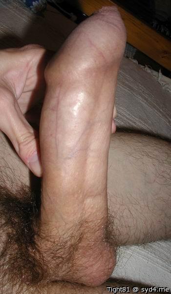 Phimosis