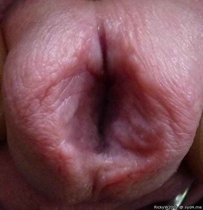 Progress with meatotomy 1