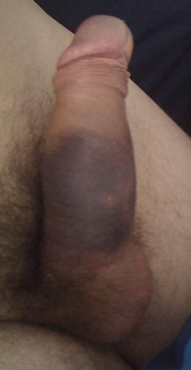 Broken Penis