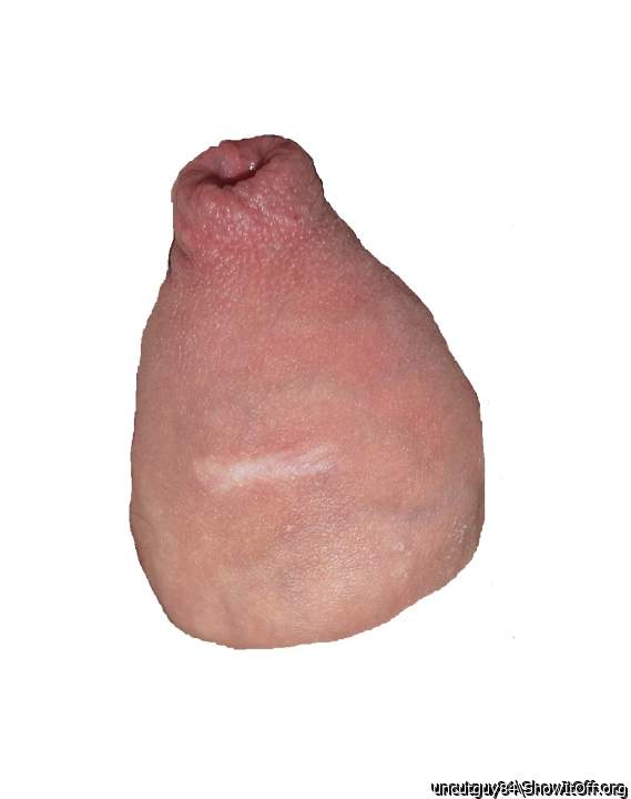 foreskin