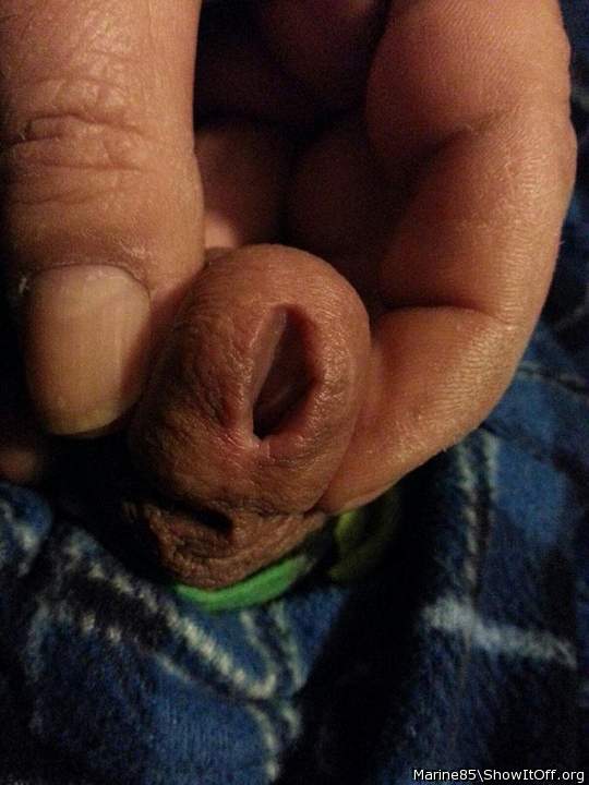 After first meatotomy cut healed