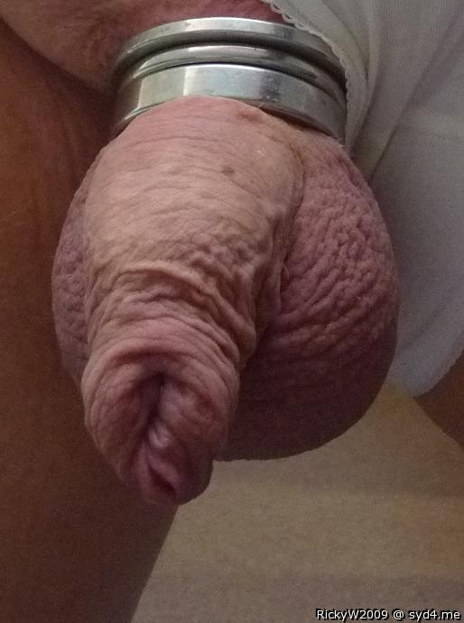 Foreskin overhang