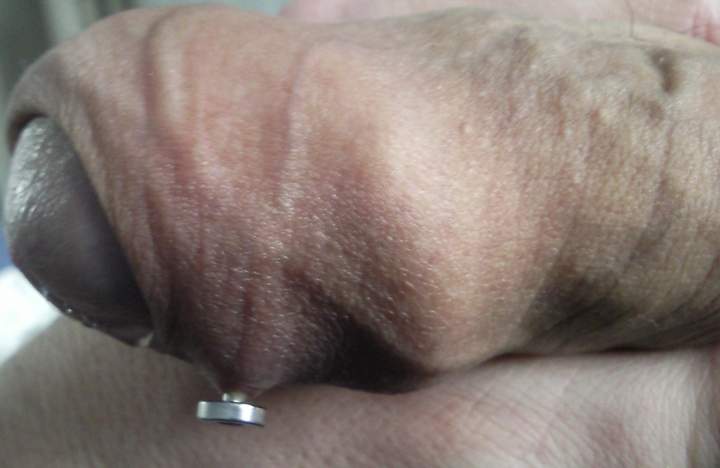 A hole through my foreskin 5