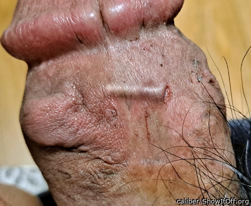 implant