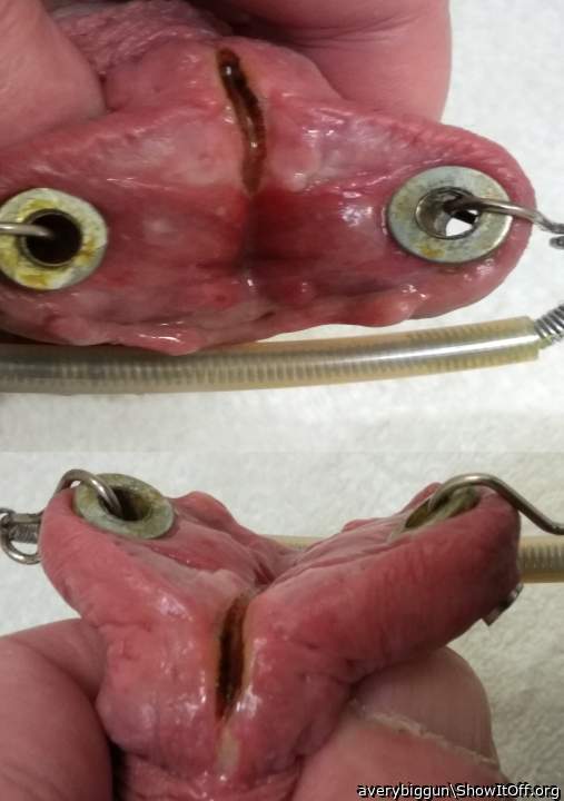 More cautery Mar 23
