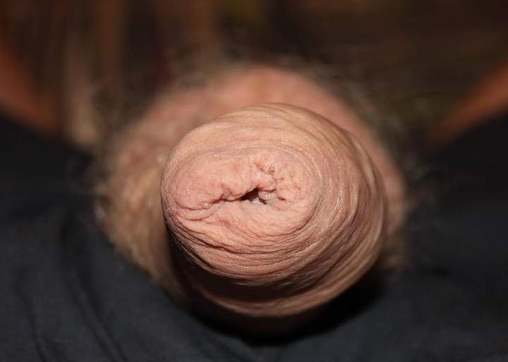 Foreskin close-up