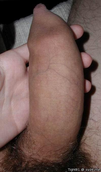 Phimosis