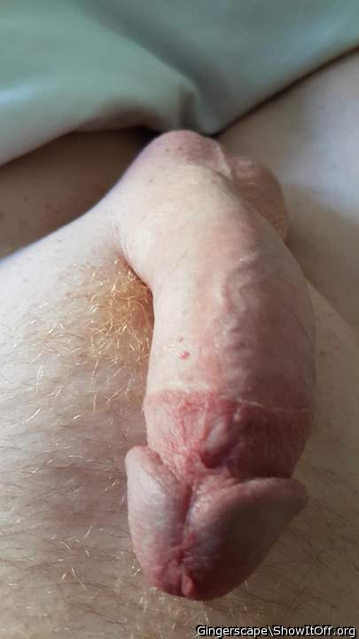 Nice circumcision and removed frenulum   