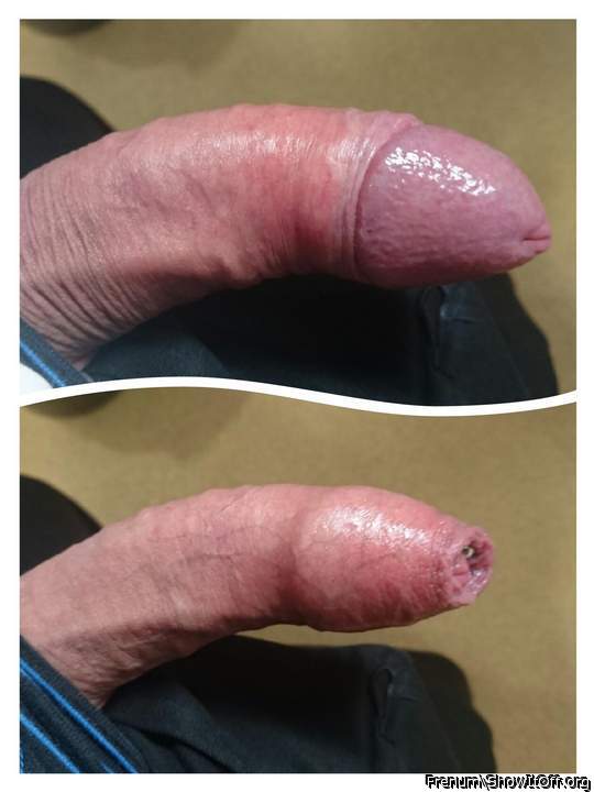 Foreskin.
