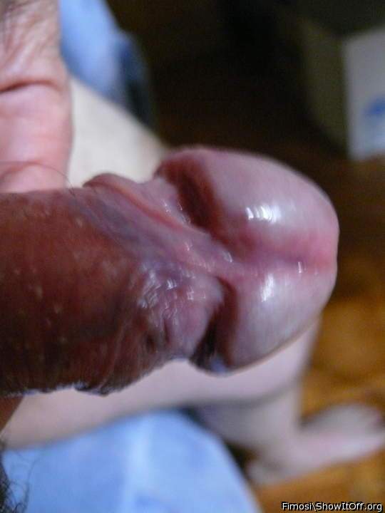 frenulum in rotation