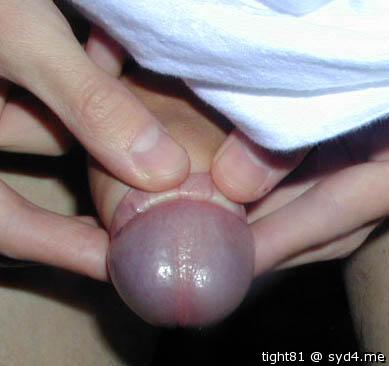Phimosis