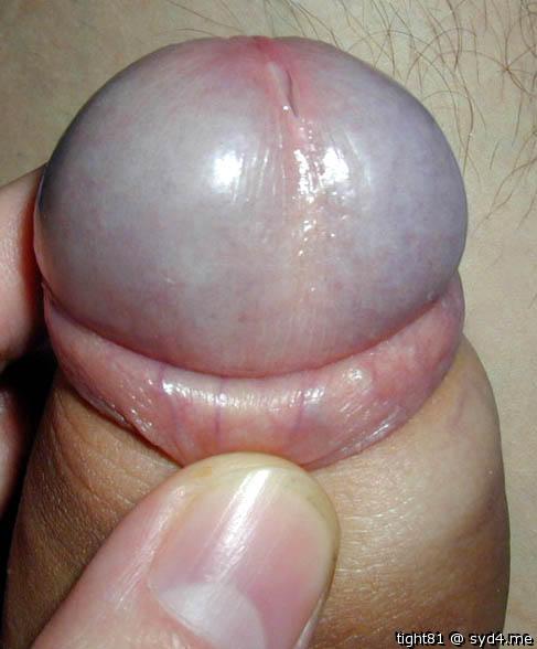 Phimosis