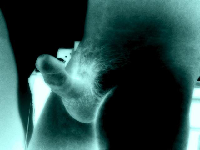X rays