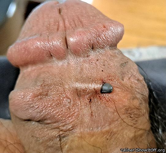 implant