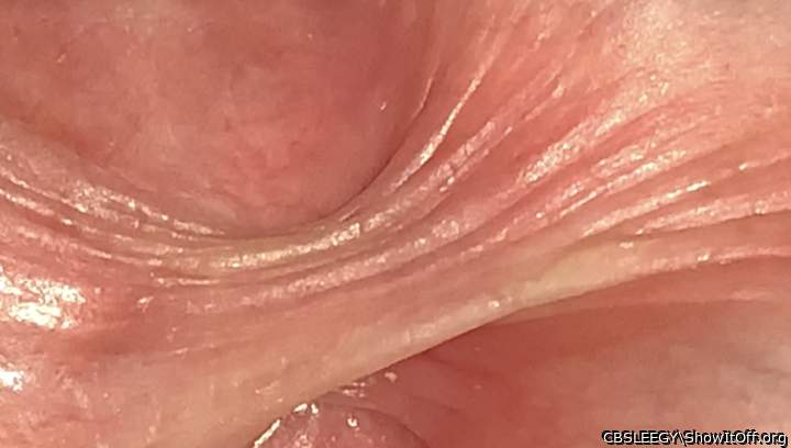 How many stretch marks on my frenulum can you see?