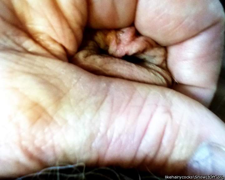 gimme some skin..... foreskin restoration2