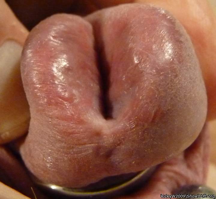 Meatotomy