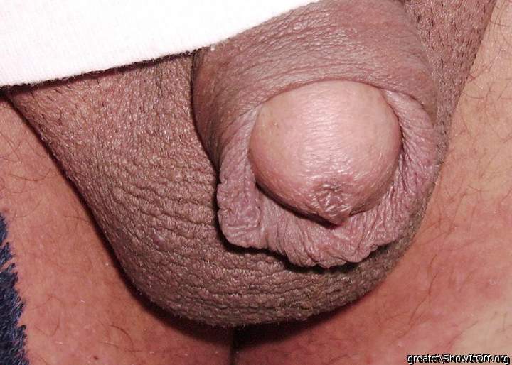 Did they give you a dorsal slit