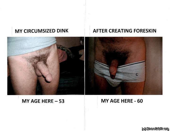 My DINK.......BEFORE....then AFTER......FORESKIN RESTORATION