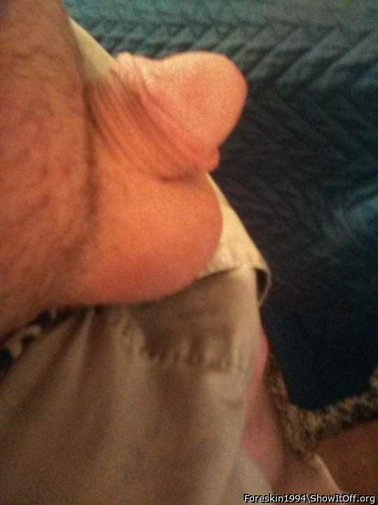 Photo of a short leg from Foreskin1994