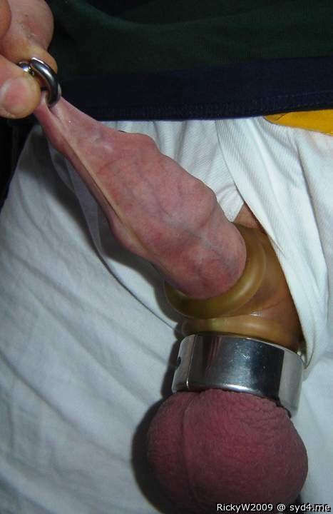 Foreskin stretch marks